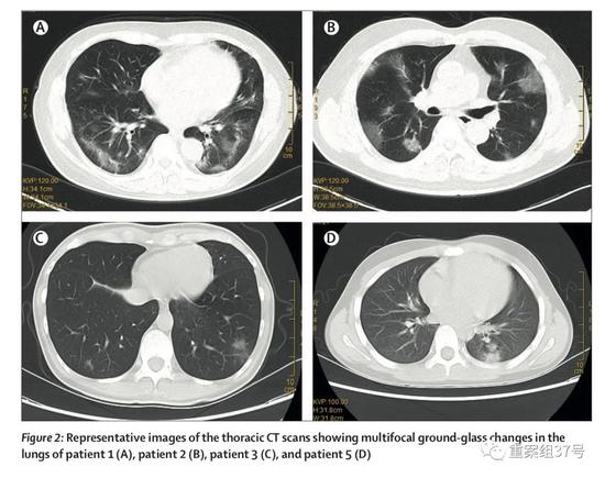  ▲有武汉旅行史的返深圳家庭中，多名家庭成员呈现肺部多发磨玻璃样改变，其中10岁的患者为无症状感染者。论文截图