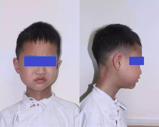  小患者入院时右脸肿胀明显，从外表看很难想到内藏异物