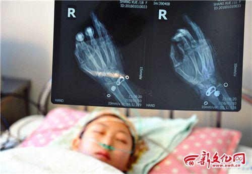女孩手上的刀伤十分严重 新文化报&nbsp;&nbsp;阚旋 摄