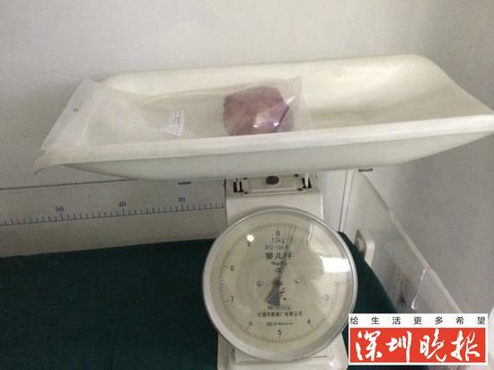 图为取出的结石