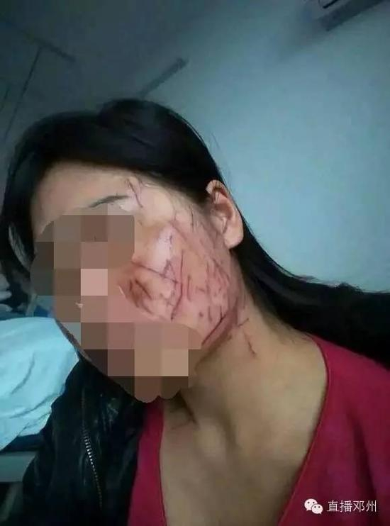 景女士脸部多处被划伤（照片由景女士提供）