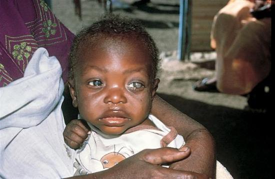 维他命A缺乏症会导致失明或死亡