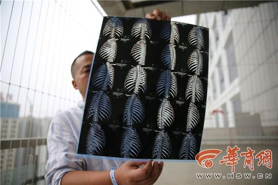 医院拍摄的片子