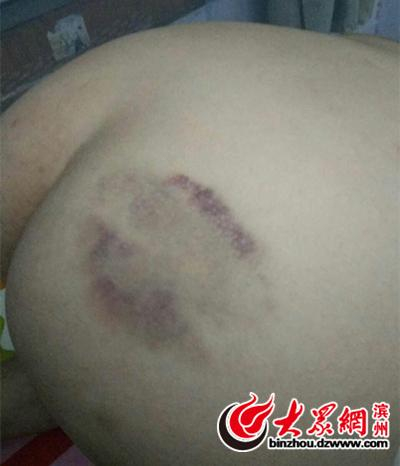 　　孩子屁股上发现淤青
