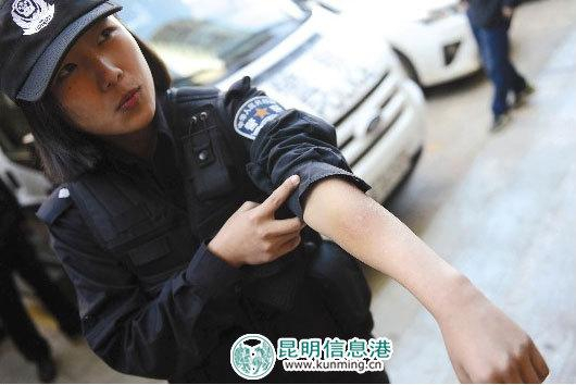 咬后，女法警的手臂留下很明显的牙印 都市时报 首席记者张玉杰