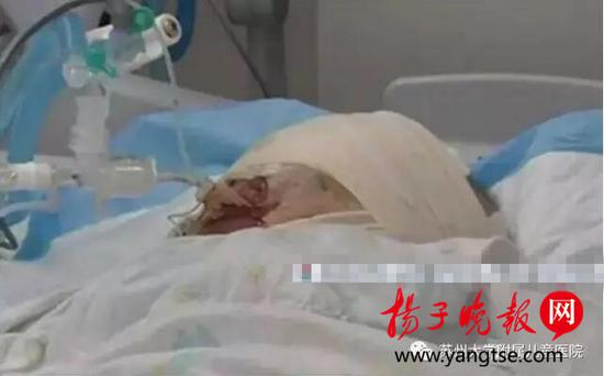 因玩吹风机被烧伤的6月大宝宝