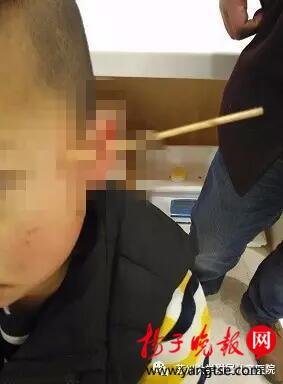 被烧烤剩下的竹签插入了头部的3岁宝宝