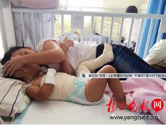 被一锅粥烫伤的2岁女童