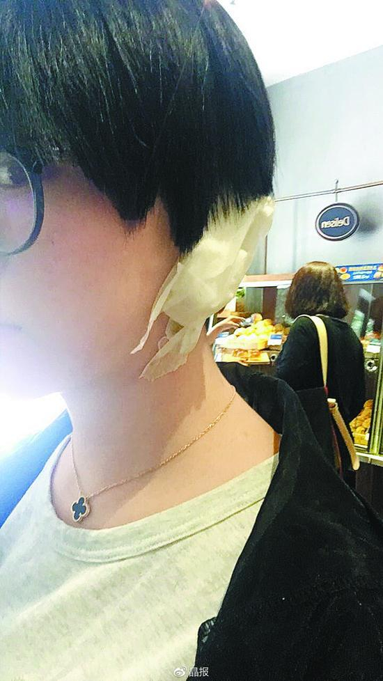 　　吴女士耳朵很受伤。