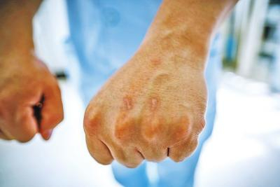 　　护士被病人抓伤是常事