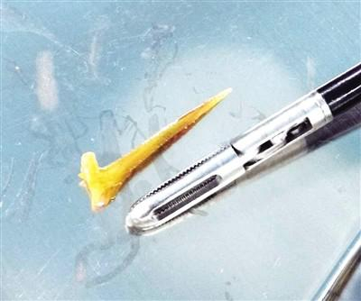 从唐先生体内取出的鱼刺。