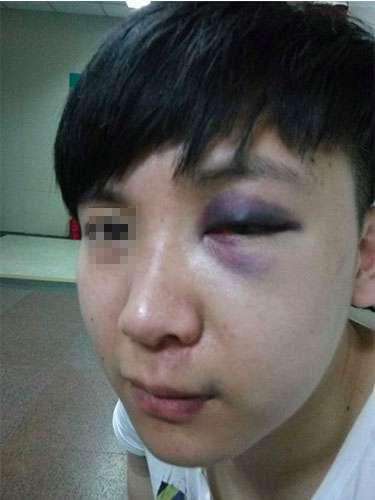 图注：当事人眼睛被打（当事人供图）&nbsp;