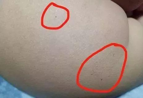据多名红黄蓝（新天地分园）家长反映，孩子腿部、屁股、腋下出现针眼。