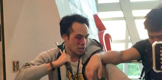 相信是便衣警察的男子被打伤眼部