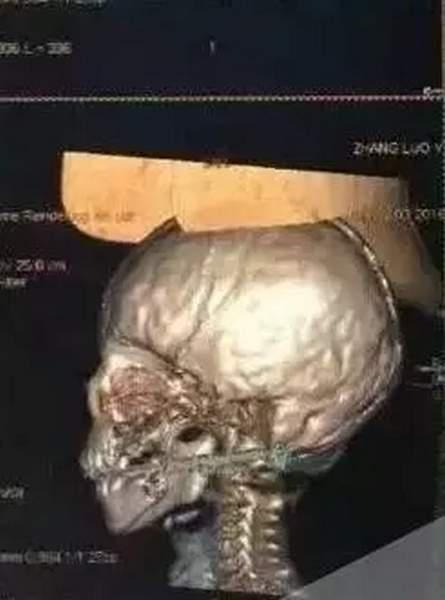 ▲医院提供的希希CT图