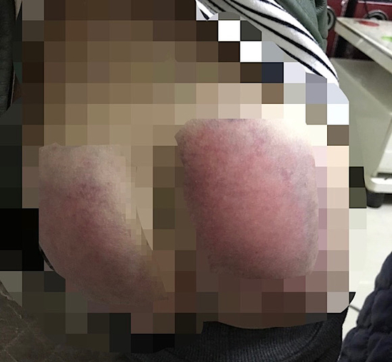 琪琪因没完成作业，双侧臀部被班主任用按摩板打得淤青。