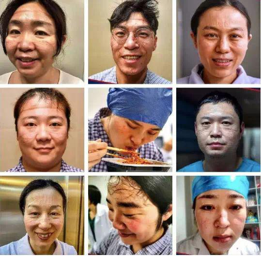 奋战武汉疫情一线医护人员因长期戴防护口罩而形成的勒痕