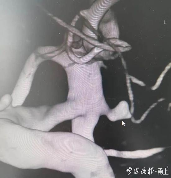 箭头的位置就是动脉瘤。