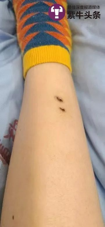  韩韩腿上被蛇咬的伤口