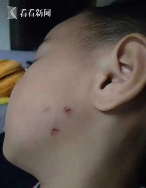 孩子的伤口