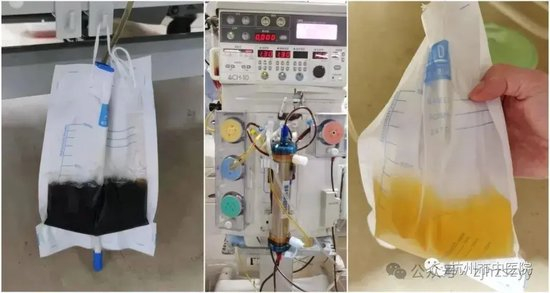 患者尿液由酱油色变为正常黄色