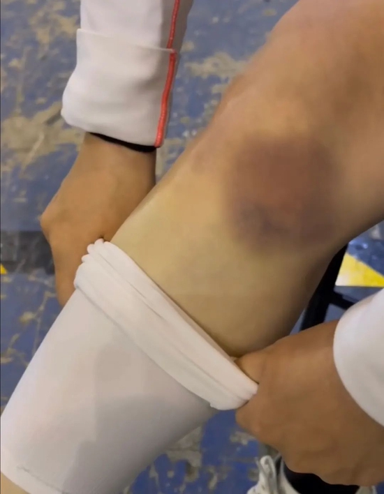 ·张含亮在练武时经常受伤。