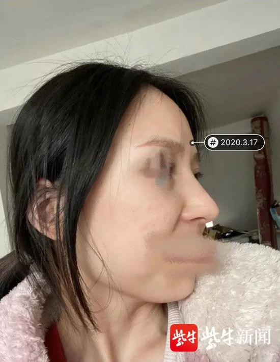 2020.3.17（第二次修复手术后两个多月）拍摄