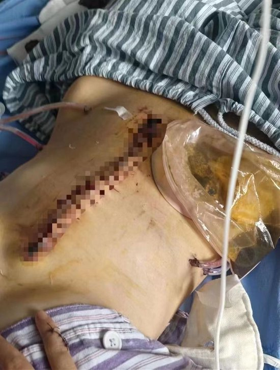 小谢腹部受伤严重，装上了粪袋。