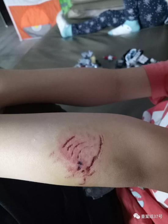 ▲另一名被咬伤5岁男孩的伤口。 &nbsp;&nbsp; 受访者供图