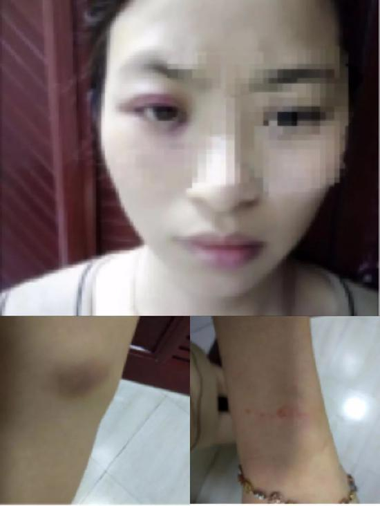 ▷周晓玲被打后的照片
