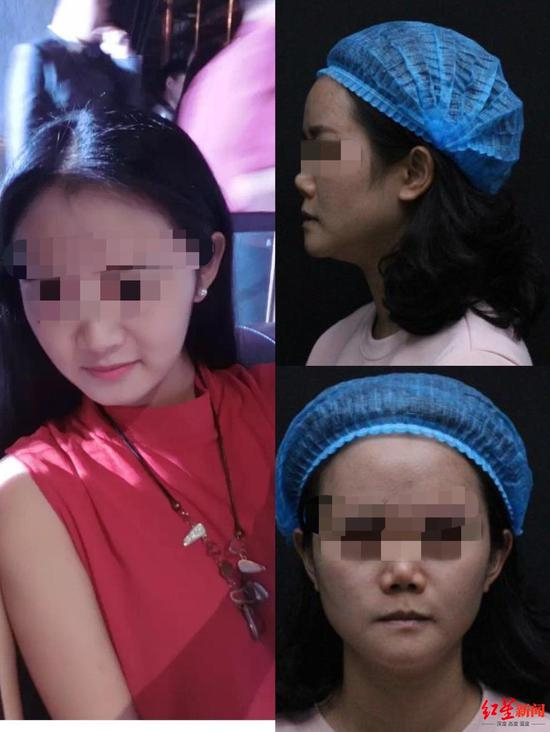 　↑宁女士手术前后对比照