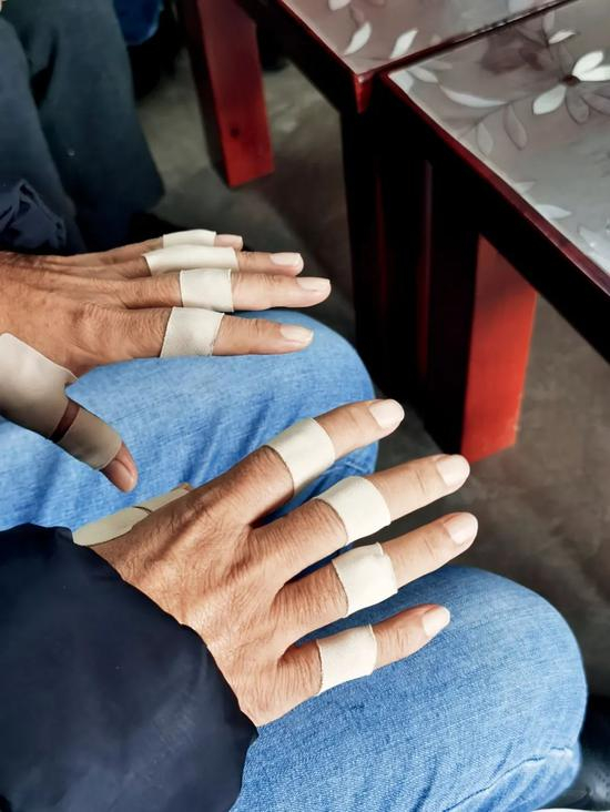 　　张桂梅身患骨瘤、肺纤维化、小脑萎缩等23种疾病，每日要在身上和手上贴满止疼膏，否则手无法弯曲。