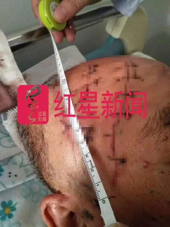  ▲被砍伤的郭三祥&nbsp;