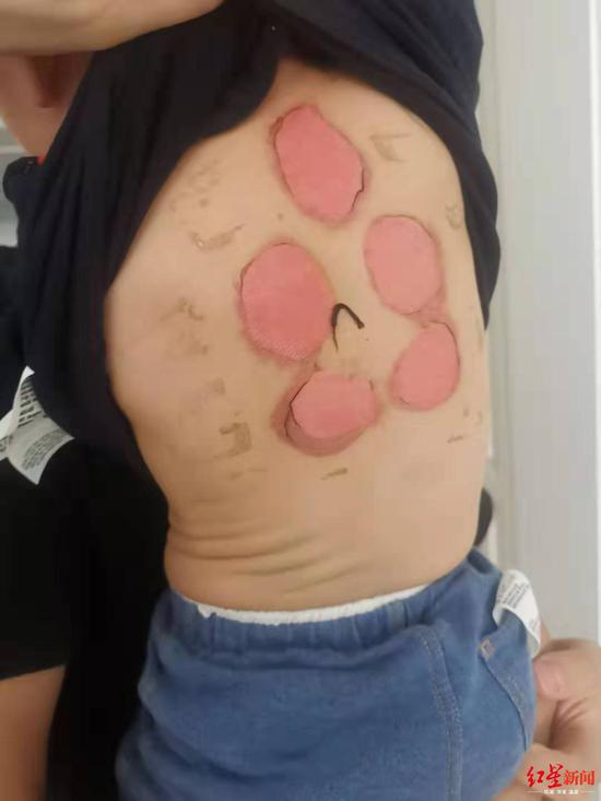 事发已4天，孩子背部灼伤处仍发红