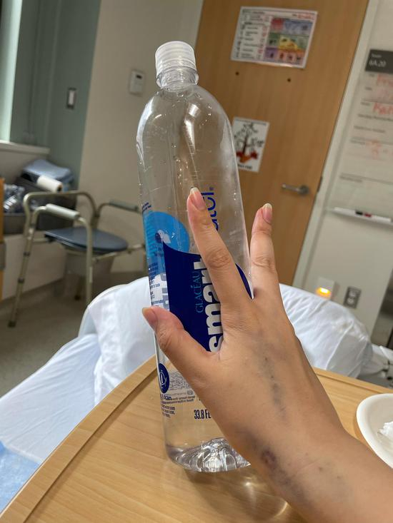  赵上上因输液打针而发青的手臂。