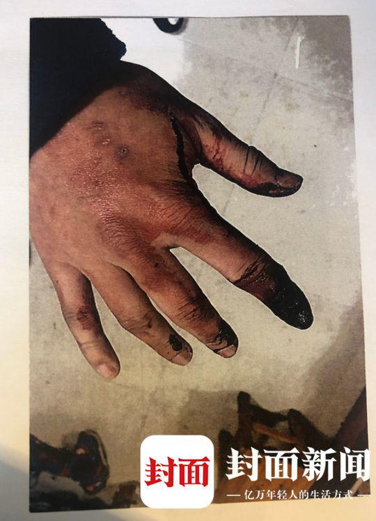  程兆东手部受伤