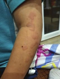 9月25日晚，峰峰左臂可以清晰看到红疹。图/受访者提供