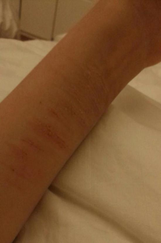 手臂上的伤痕。