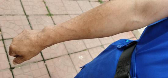 队员们的手上满是伤口，都是在山野救援时被植被划伤的。郑子愚摄