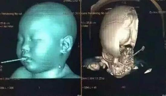 ▲医院提供的希希CT图