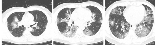 医院供图 治疗前胸部CT（两肺弥漫性磨玻璃样渗出）