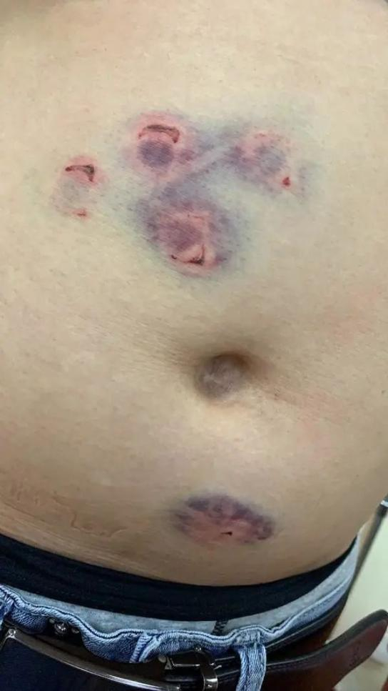 （图为楼上男主人被楼下郑太太用高跟鞋鞋跟凿伤）