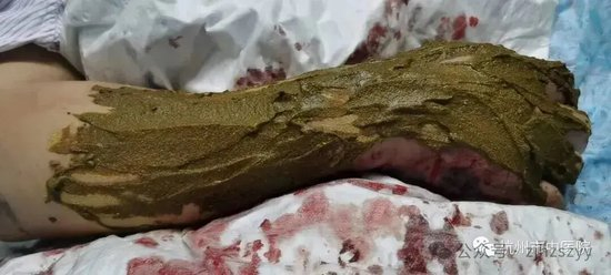 　患者正在敷药治疗