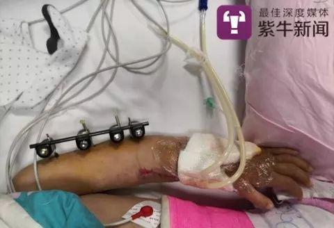  孩子的左臂被保住了