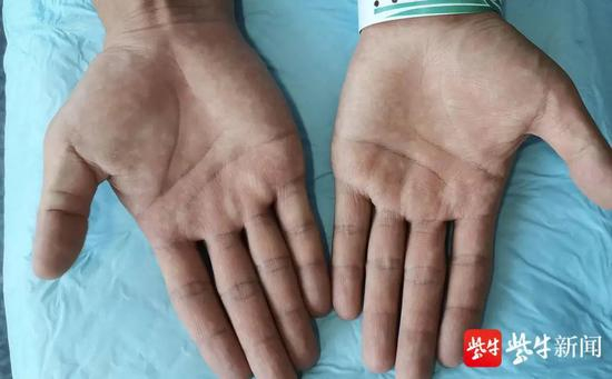 手术后他的手变干了