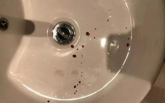 白先生说，摔倒后鼻子就流了鼻血