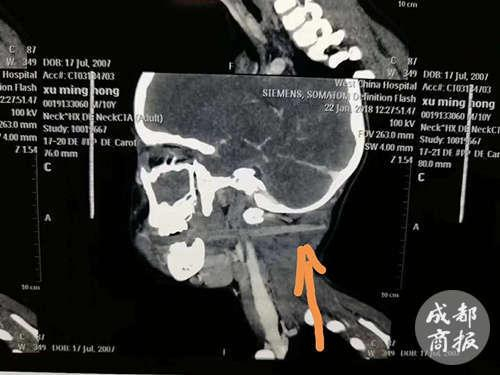 孩子被筷子插喉咙