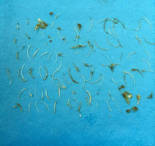 医生取出鱼刺后，用水洗掉粪便后的情况。