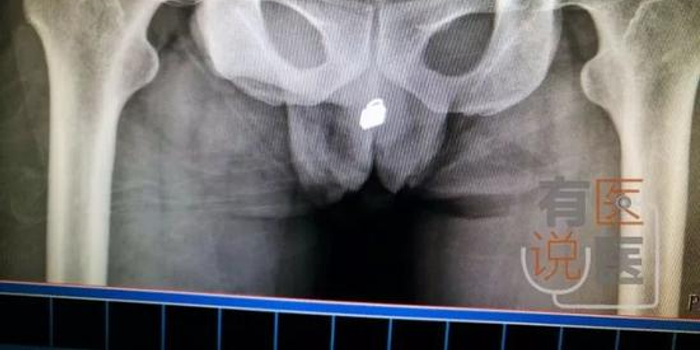 吸毒男子把锁头从尿道塞进膀胱 医生拍片后吓一跳