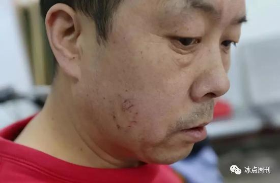 2018年3月8日，西安，102路公交车司机张师傅提醒酒后上车的3名乘客投币或刷卡，被辱骂殴打，右脸颊被咬伤。车队为其申请“委屈奖”。视觉中国供图